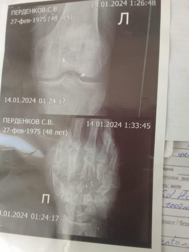 На фото рентгеновский снимок ранения бойца на фронте спецоперации на Донбассе.